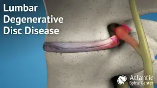 Lumbar Degenerative Disc Disease