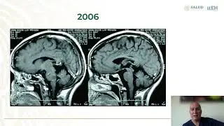 Diagnóstico diferencial en esclerosis múltiple