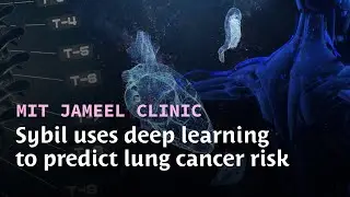 Sybil: Transforming lung cancer prediction with AI