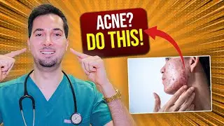 How To Get Rid Of Acne Overnight And Pimples | Pharmacist Explains