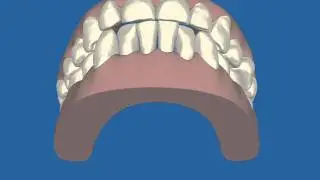 Invisalign Clincheck 1