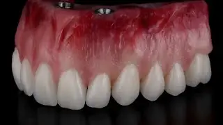 👉 Montagem de Dentes na Prótese Total | Passo a Passo ao Vivo