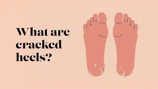 Dry & Cracked Heels | TheWalkingCompany | Keep On Walking