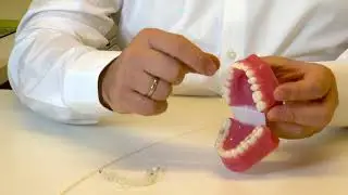 Wie funktionieren die Invisalign-Schienen?