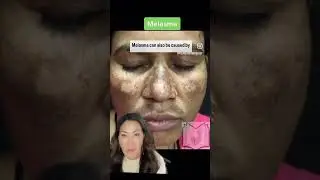 Melasma vs Sun Spots #melasma #sunspots #dermatology