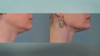 Christine D. Brown M.D., P.A. - ThermiRF Wrinkle Reduction