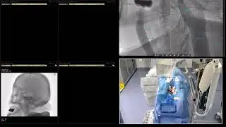 Case-5, ICA stenosis, 13-01-2026