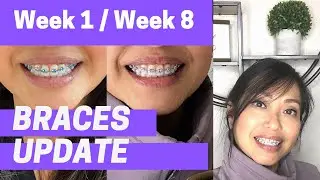 ADULT BRACES | 2 Month Update: 2nd Visit with Ortho