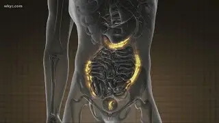 The mysterious rise of colon cancer among Gen-Xers and Millennials