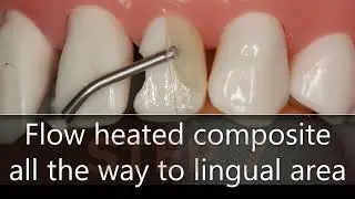 Black Triangle Closure with composite - XBD