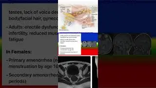 Signs and Symptoms of HYPOGONADOTROPIC HYPOGONADISM #medicalknowledgeonline #science #nurse