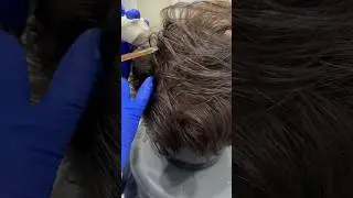 PRP for Hair loss #prp #prpkit #dermatologist #plateletrichplasma