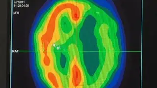New drug approved for patients with severe depression