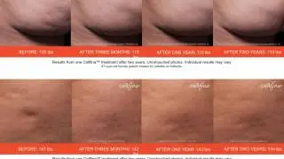 Cellfina Before and After Photos