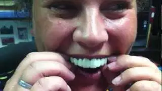 Snap On Smile Alternative: The MOST AMAZING Before and After!!!