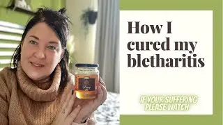 How I cured my BLEPHARITIS / chronic eye condition
