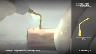PIEZOSURGERY - HANDS-ON - Correction of the implant axis