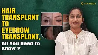 All Transplants at New Roots: Hair, Eyebrow & Moustache FULL Breakdown 🙂