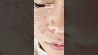 【開き毛穴・凸凹毛穴・すり鉢毛穴】毛穴には医療の力が1番？ダーマペンもレーザー治療も散々して来た私。(金ドブでした) #毛穴 #毛穴ケア #美容 #スキンケア #メイク #毛穴パック