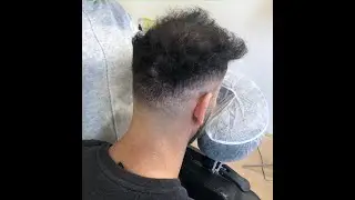 Scalp Micropigmentation V Hair Transplant