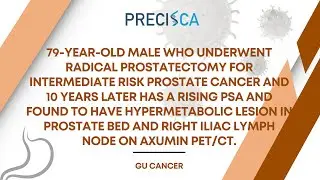 Expert Cancer Panel: History of prostate cancer s/p surgery now with recurrence after 10 years