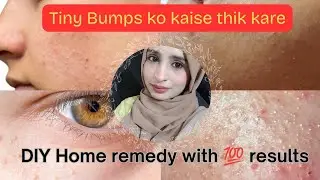 Remove Tiny Bumps & Texture Naturally | Get Smooth Clear Skin in 7 Days || 💯 results in just 7days