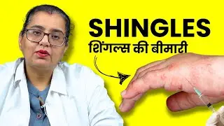 Shingles Ki Bimari Kya Hoti Hai? Kaise Hoti Hai? Symptoms, Vaccine & Treatment in Hindi