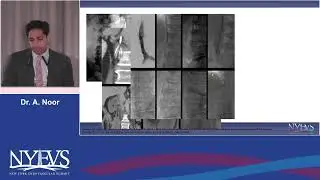 Who should get IVC filter retrieval an evidence based apporach Amir Noor Session IV Inferior vena ca
