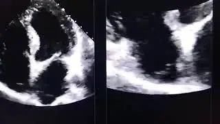 Chiari network in the right atrium; Normal anatomical variant 