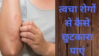 त्वचा रोगों से कैसे छुटकारा पाएं#skin diseases cure..#Ayurvedic treatment