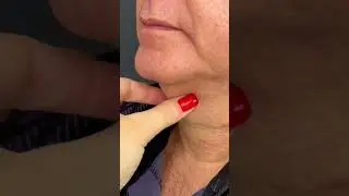Antes e Depois - Ultraformer no pesco&ccedil;o