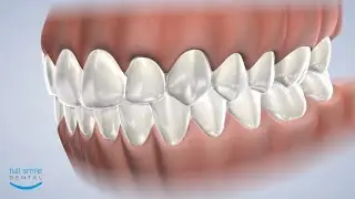 Zoom&reg; Teeth Whitening at Full Smile Dental: Dentist in Dumas, Canyon, Amarillo, Farwell, Dalhart, TX