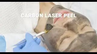 Carbon Peel Laser &ndash; The Ultimate Skin Rejuvenation Treatment!