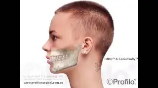 IMDO & Genioplasty