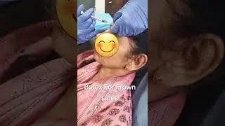 Botox for frown lines #wrinkles #frownlines #botox #botoxinjections #botoxfiller #foreheadlines