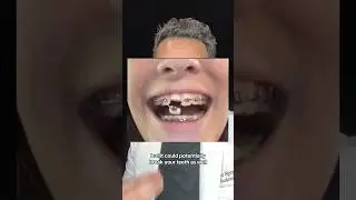 Things NOT to do when you first get Braces