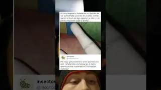 Descubre Que Le Falta Media Falange Y Reacciona Tarde