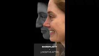4D Nose Approach - 3 Months After Rhinoplasty | As Seen On Instagram