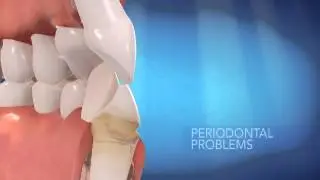 Invisalign  Why are crooked teeth a problem - Available at Flatirons Family Dental in Superior, CO