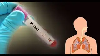 Cudurka Oof Wareen (Pneumonia)