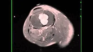 Enchondroma, Tibia
