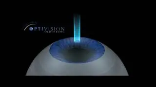 Femto Lasik