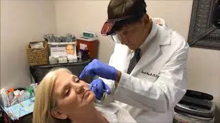 Bellafill injection with microcannula technique