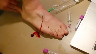 How not to take a blood sample