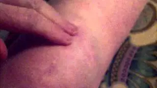 Left Knee 34 Weeks Post-op After Patella Re-alignment Operation