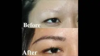 Eyebrow Transplant for Women Manila Philippines by Manzanares Hair Restoration Center