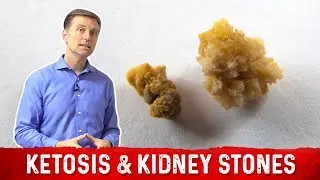 Ketosis and Kidney Stone Prevention &ndash; Dr. Berg