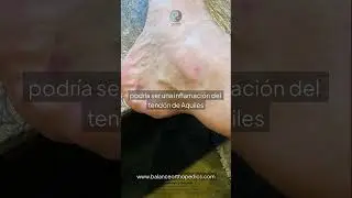 🦴 &iquest;Espol&oacute;n o Fascitis Plantar? Aprende a distinguirlos.