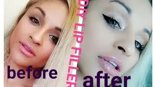 DIY LIP FILLERS| AT HOME LIP INJECTIONS