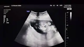  17w fetus  with cystic hygroma,with  (micromelia), and a small thoracic cage .. skeletal dysplasia